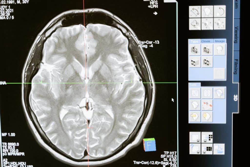 Hypersignaux-punctiformes-et-sep-diagnostic