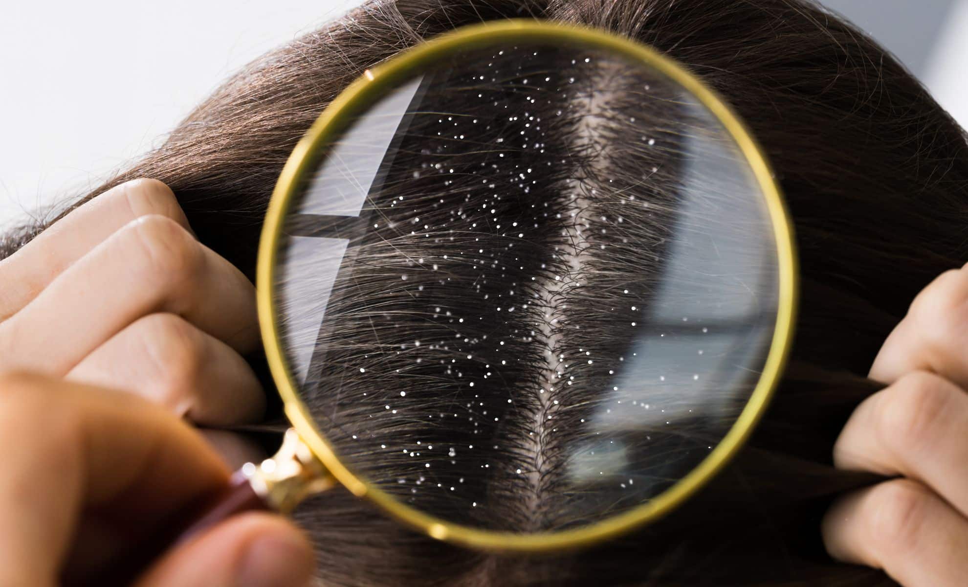 La vérité sur les shampooings antipelliculaires : découvrez ceux qui fonctionnent vraiment en 2023 !